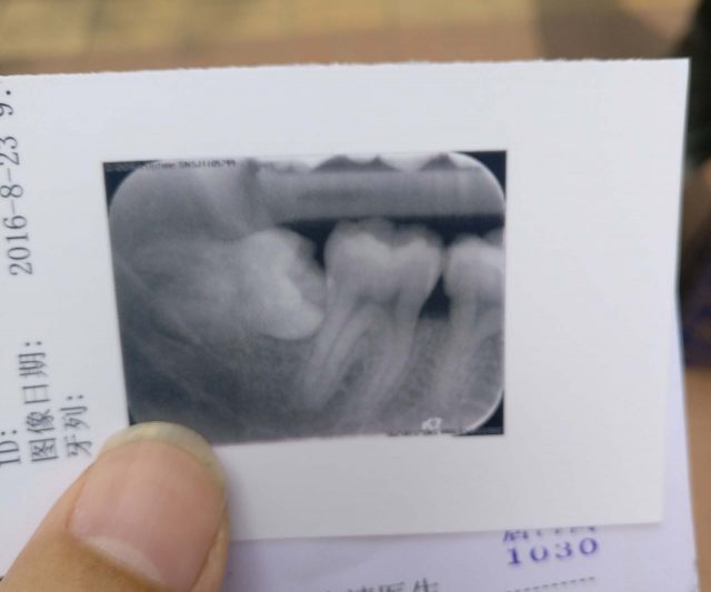 牙齿X光照片